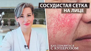 Купероз и его причины | Сосудистая сетка | Уход за кожей