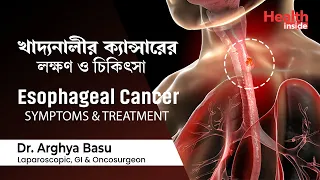 খাদ্যনালীর ক্যান্সারের লক্ষণ ও চিকিৎসা | Esophageal cancer symptoms and treatment in Bengali