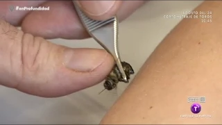 Relájate con picaduras de abeja