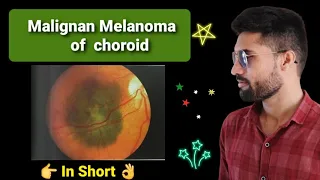 Malignant Melanoma of choroid lecture opthalmology