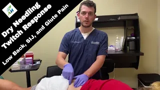 Dry Needling Muscle Twitch Response Lower Back and Glutes