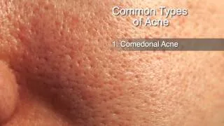 How to Treat Different Types of Acne