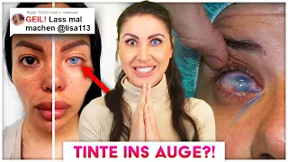 Verbotene Augen OP die in Deutschland beworben wird!