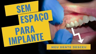 MEU DENTE DESCEU!!! FALTA DE ESPAÇO PARA FAZER UM NOVO DENTE