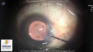 Dr Sourabh Patwardhan Live Cataract surgery. For training and consultation call 9220001000
