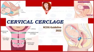 Cervical Cerclage , RCOG Guideline (2022)