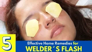 Top 5 Home Remedies To Treat Welder's Flash - Eye Pain Home Remedies - Arc Eye Home Remedies