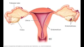 Hidden In Plain Sight - Endometriosis