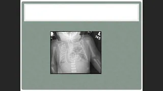 Peads Lecture 18   Resp disorders in newborn