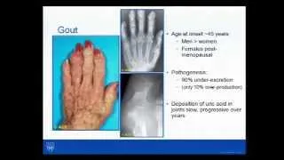 Rheumatology Pearls- Dr. John M. Davis, III, 8/20/14