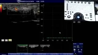 NextGen LOGIQ e: Color Quantification