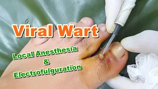 Treatment of Viral Wart on Foot (Big Toe) by Electrofulguration | Electric Cautery | HPV