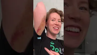 How do bruises work?
