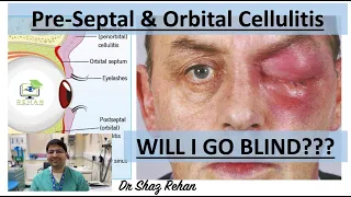 Cellulitis: Learn All About Pre-Septal & Orbital Cellulitis I Dr Shaz Rehan, 2023