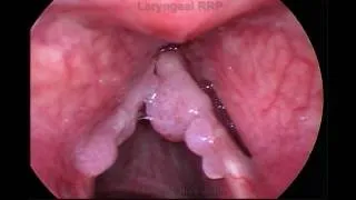 Laryngeal papilloma - MGH Voice Center (Ex 1)