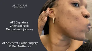 Chemical Peel Journey (by @Motriesit )