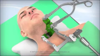 CS-1600L Cervical Retractor Animation