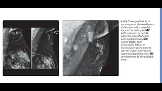 Breast imaging ultrasound /radiology/sonology @RadiologyChannel