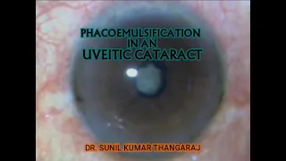 Phacoemulsification in a uveitic cataract