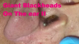 Giant Blackheads  - Part II-