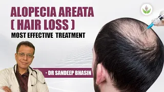 Alopecia Areata (Hair Loss) Most Effective Treatment - Dr Sandeep Bhasin | Care Well Medical Centre