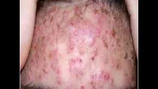 Pimple popping and blackheads removal (372)