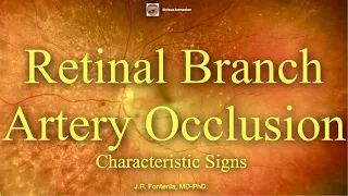 Branch Retinal Artery Occlusion. Characteristic Signs.