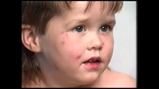 Varicella (Chicken Pox)