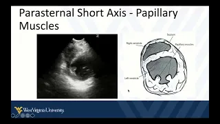 Cardiopulmonary POCUS 3 - The Parasternal Short Axis View