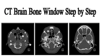 CT head bone window axial skull base step by step