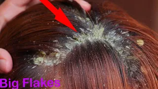 BIG DANDRUFF FLAKES Scalp scratching and picking  Satisfying Dandruff Removal # 12