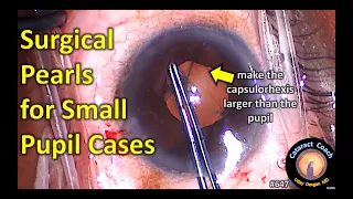 Surgical Pearls for Small Pupil Cataract Surgery