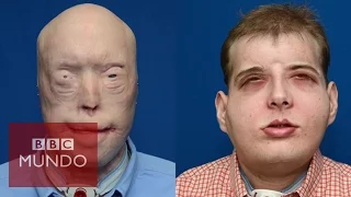 El trasplante de cara más completo de la historia