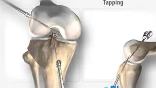 FH Orthopedics, Inc CoLS ACL Fixation in 3D