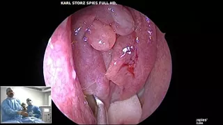 FESS Unedited ( Case 5 ) - Dr. Satish Jain - www.skullbase360.in