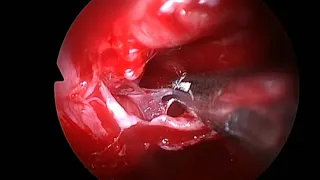 PITUITARY GH ADENOMA, ANOTHER ACROMEGALY CASE, 31 YEARS OLD FEMALE, ENDOSCOPIC TS SURGERY