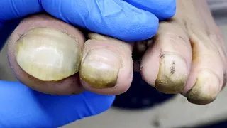 Wow~ toenails are very long and bent down!【Pedicure Master Lin Jun】