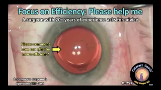 CataractCoach™1757: focus on efficiency: please help me