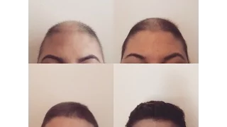 A Picture Every Week For A Year - Post Chemotherapy/Radiation Hair Growth