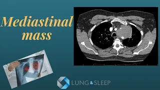 Mediastinal mass - what is the cause? Lymphoma, small cell carcinoma, sarcoid or tuberculosis