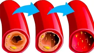 ЭТИ 10 Продуктов Чистят Сосуды и Снижают Риск Инфаркта