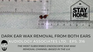 EAR WAX REMOVAL FROM BOTH EARS - EP 316