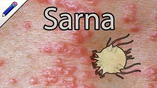 Sarna Humana Escabiosis ¿Cómo saber si tengo Sarna? Síntomas Tratamiento Cura