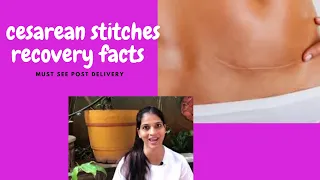 cesarean stitches recovery facts| after delivery care in hindi| stitches healing process