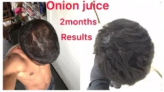 Best hair growth result in 2 months using ONION JUICE #hairloss#hairgrowth #hair #trending #hairfall