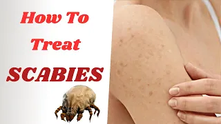 How To Treat Scabies Effectively | From PERMETHRIN Cream To IVERMECTIN Tablets