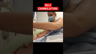 Dialysis Self cannulation of AV fistula | Self cannulation of fistula needle #amazing