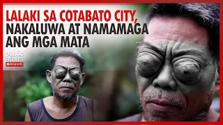 Lalaki sa Cotabato City, nakaluwa at namamaga ang mga mata | Public Affairs Exclusives