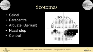 7 EXAMINATION Visual Field Changes in Glaucoma