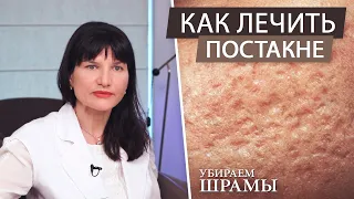 Как лечить постакне. Убираем рубцы и шрамы. Правильный уход за кожей